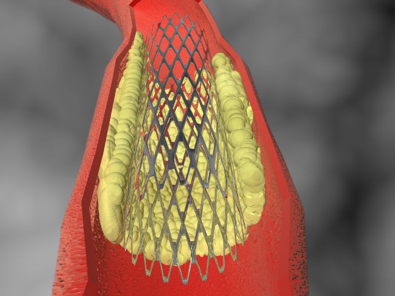 Ilustración de un stent expandido dentro de una arteria con placa de colesterol