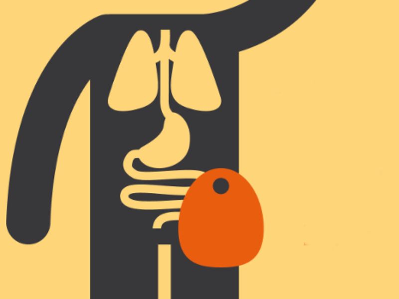 Ilustración de un stent expandido dentro de una arteria con placa de colesterol